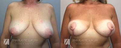 Breast Lift + Implants Before & After Gallery - Patient 106400597 - Image 1