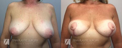 Breast Lift + Implants Before & After Gallery - Patient 106400597 - Image 1