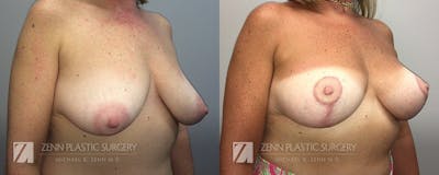 Breast Lift + Implants Before & After Gallery - Patient 106400597 - Image 2