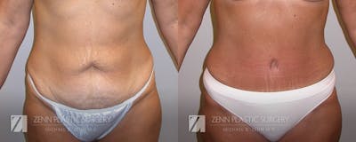 Tummy Tuck Before & After Gallery - Patient 106400598 - Image 1