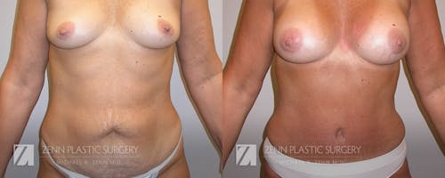 Gallery Before Image