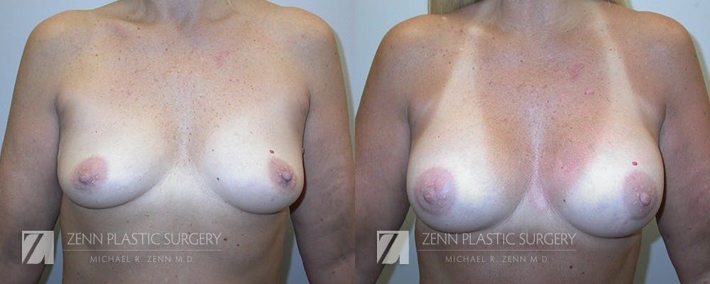 Mommy Makeover Before & After Gallery - Patient 106400601 - Image 2