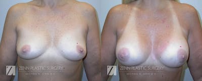 Mommy Makeover Before & After Gallery - Patient 106400601 - Image 2