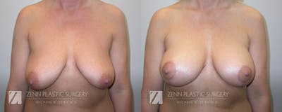 Breast Lift + Implants Before & After Gallery - Patient 106400599 - Image 1