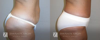 Tummy Tuck Before & After Gallery - Patient 106400598 - Image 2