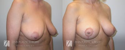 Breast Lift + Implants Before & After Gallery - Patient 106400599 - Image 2