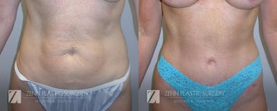 Tummy Tuck Before & After Gallery - Patient 106400602 - Image 1