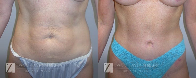 Tummy Tuck Before & After Gallery - Patient 106400602 - Image 1