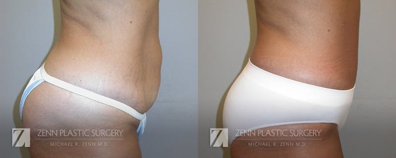 Mommy Makeover Before & After Gallery - Patient 106400601 - Image 4