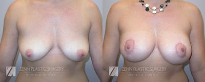 Breast Lift + Implants Before & After Gallery - Patient 106400604 - Image 1