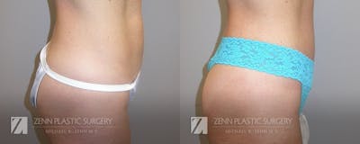 Tummy Tuck Before & After Gallery - Patient 106400602 - Image 2