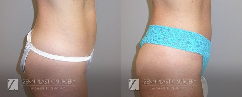 Tummy Tuck Before & After Gallery - Patient 106400602 - Image 2