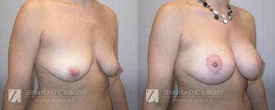 Breast Lift + Implants Before & After Gallery - Patient 106400604 - Image 2