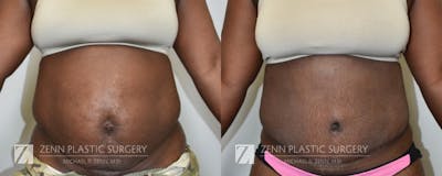 Tummy Tuck Before & After Gallery - Patient 106400605 - Image 1