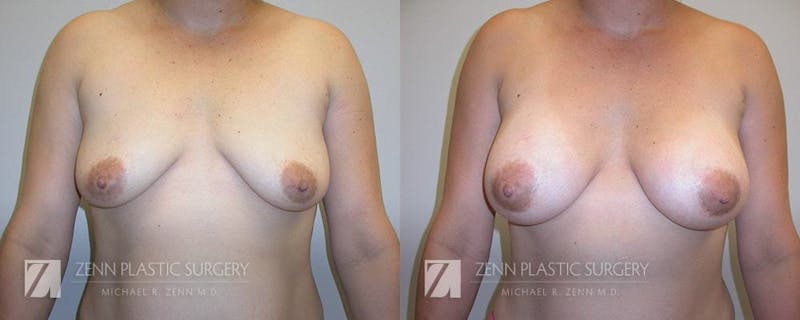 Mommy Makeover Before & After Gallery - Patient 106400607 - Image 2