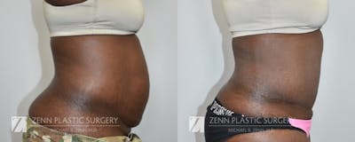 Tummy Tuck Before & After Gallery - Patient 106400605 - Image 2