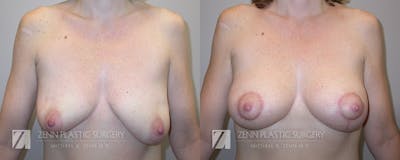 Breast Lift + Implants Before & After Gallery - Patient 106400606 - Image 1
