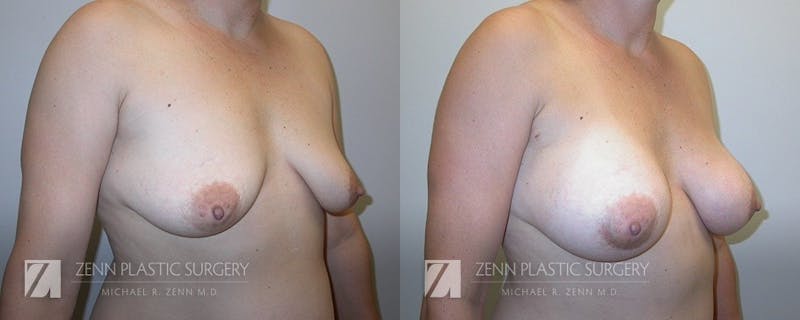 Mommy Makeover Before & After Gallery - Patient 106400607 - Image 3