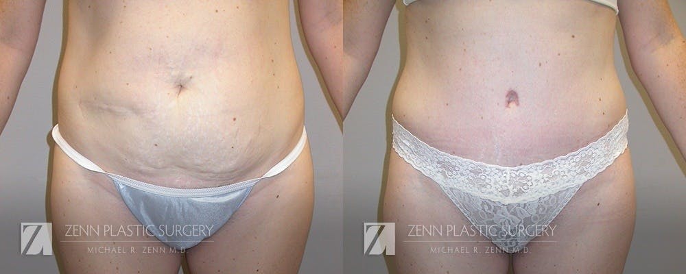 Tummy Tuck Before & After Gallery - Patient 106400608 - Image 1