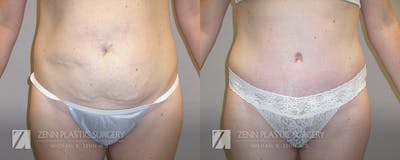 Tummy Tuck Before & After Gallery - Patient 106400608 - Image 1