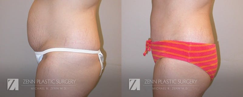 Mommy Makeover Before & After Gallery - Patient 106400607 - Image 4
