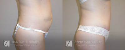 Tummy Tuck Before & After Gallery - Patient 106400608 - Image 2
