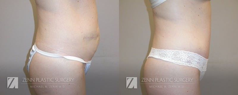 Tummy Tuck Before & After Gallery - Patient 106400608 - Image 2