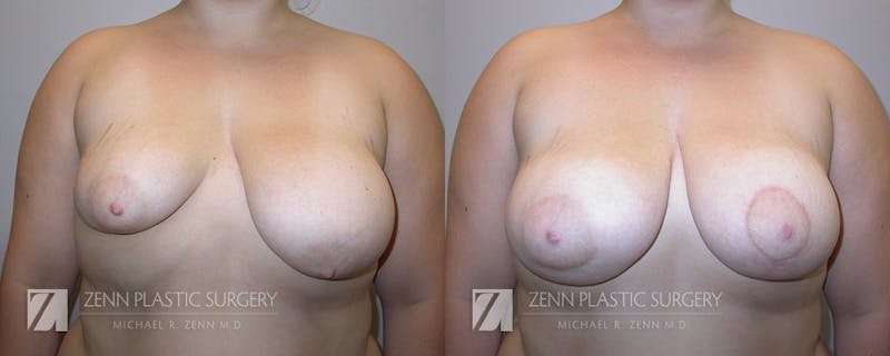 Breast Lift + Implants Before & After Gallery - Patient 106400609 - Image 1