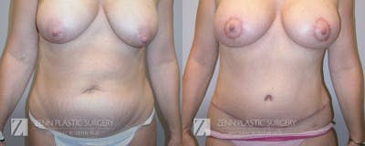 Mommy Makeover Before & After Gallery - Patient 106400614 - Image 1