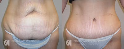 Tummy Tuck Before & After Gallery - Patient 106400610 - Image 1