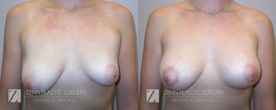 Breast Lift + Implants Before & After Gallery - Patient 106400611 - Image 1