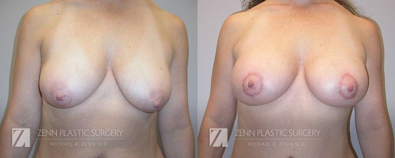 Mommy Makeover Before & After Gallery - Patient 106400614 - Image 2