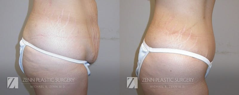 Tummy Tuck Before & After Gallery - Patient 106400610 - Image 2