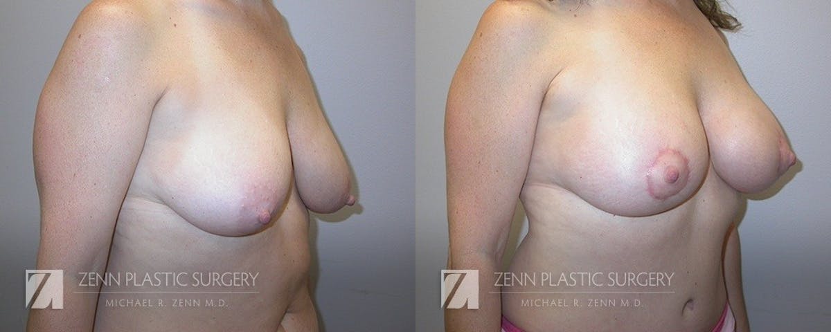 Mommy Makeover Before & After Gallery - Patient 106400614 - Image 3