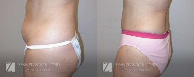 Mommy Makeover Before & After Gallery - Patient 106400614 - Image 4