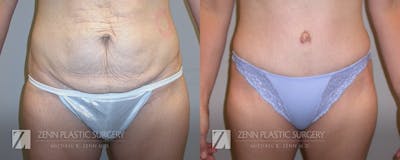 Tummy Tuck Before & After Gallery - Patient 106400616 - Image 1