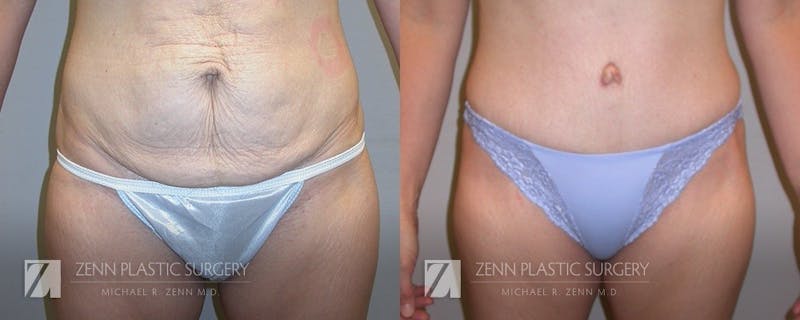 Tummy Tuck Before & After Gallery - Patient 106400616 - Image 1