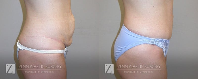 Tummy Tuck Before & After Gallery - Patient 106400616 - Image 2
