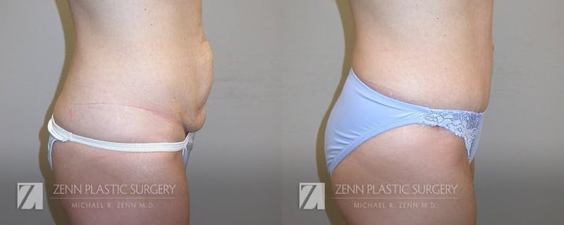 Tummy Tuck Before & After Gallery - Patient 106400616 - Image 2