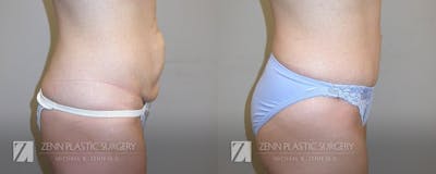 Tummy Tuck Before & After Gallery - Patient 106400616 - Image 2