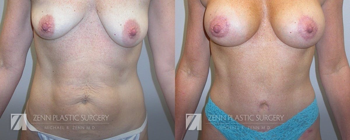 Mommy Makeover Before & After Gallery - Patient 422632 - Image 1