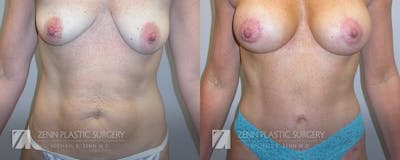 Mommy Makeover Before & After Gallery - Patient 106400618 - Image 1