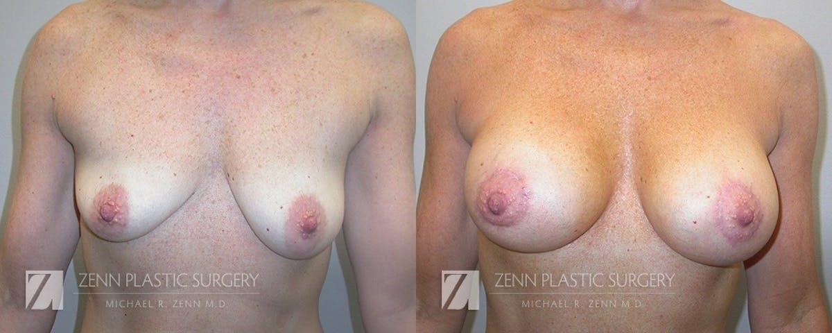 Mommy Makeover Before & After Gallery - Patient 422632 - Image 2