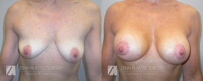 Mommy Makeover Before & After Gallery - Patient 106400618 - Image 2