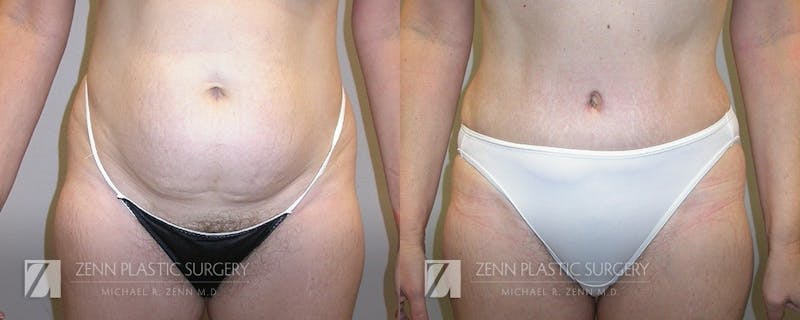 Tummy Tuck Before & After Gallery - Patient 106400617 - Image 1
