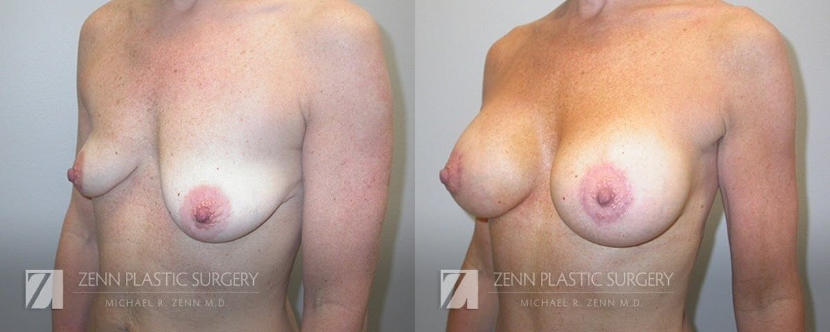 Mommy Makeover Before & After Gallery - Patient 422632 - Image 3