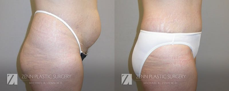 Tummy Tuck Before & After Gallery - Patient 106400617 - Image 2