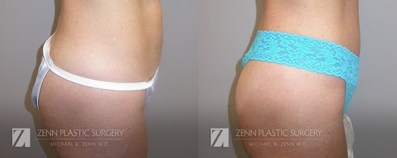 Mommy Makeover Before & After Gallery - Patient 106400618 - Image 4
