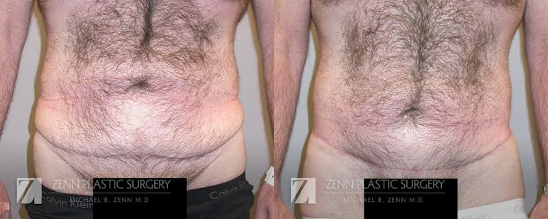Tummy Tuck Before & After Gallery - Patient 106400619 - Image 1