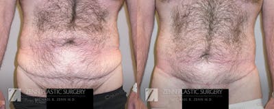 Tummy Tuck Before & After Gallery - Patient 106400619 - Image 1